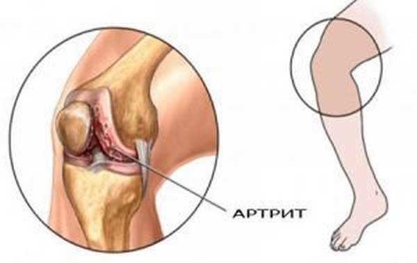 Виды и лечение контрактуры колена